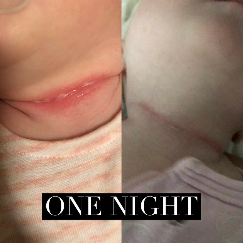 PREORDER ONLY ByeBye Stretch Marks,Mosquitos,Burns - Picture 10 of 16